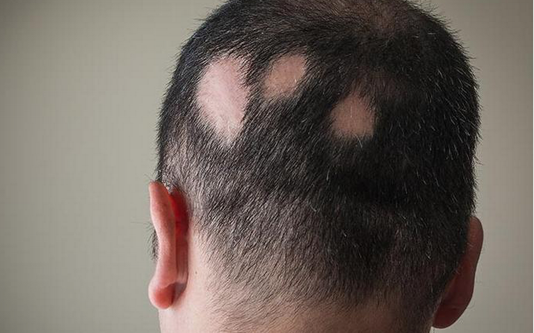 Alopecia, un problema silencioso - El Sol de Tampico | Noticias Locales,  Policiacas, sobre México, Tamaulipas y el Mundo